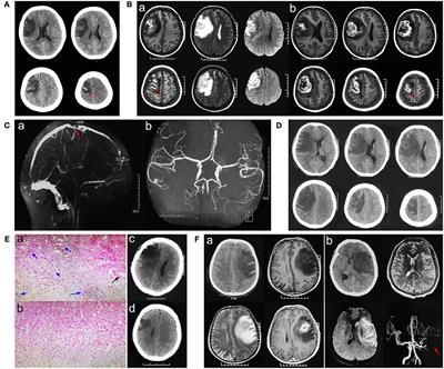 Case report: An illusive cortical venous infarction mimicking glioma hemorrhage